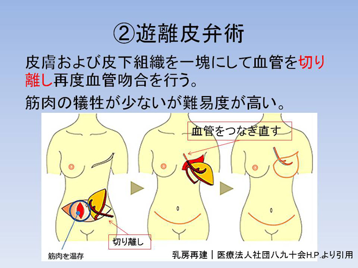 3097円 ◆高品質 下腹部ニッパー 乳房再建 腹壁瘢痕ヘルニア 腹部膨隆 術後